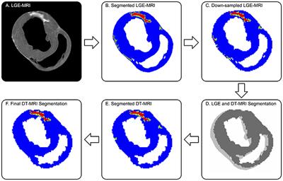 Microstructural Infarct Border Zone Remodeling in the Post-infarct Swine Heart Measured by Diffusion Tensor MRI